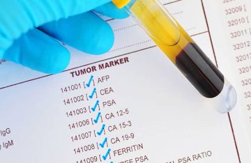 Tumor marker testing Blood sample for tumor marker testing